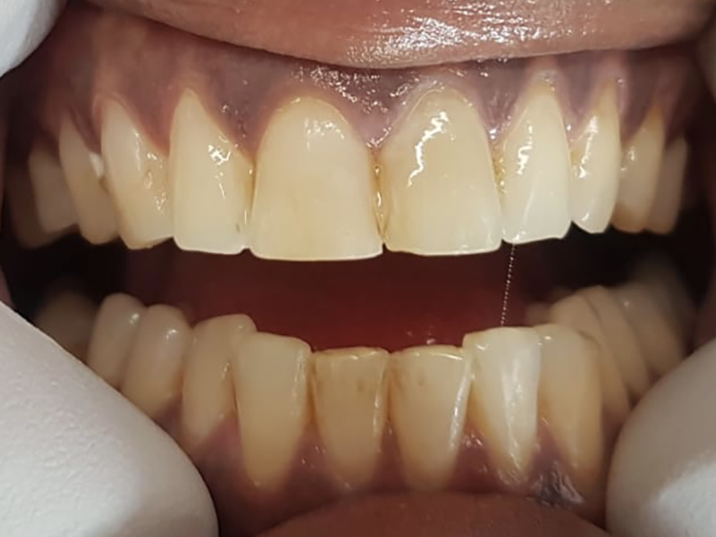 Before-Verkleurde en onregelmatige tanden, diverse slijtage’s