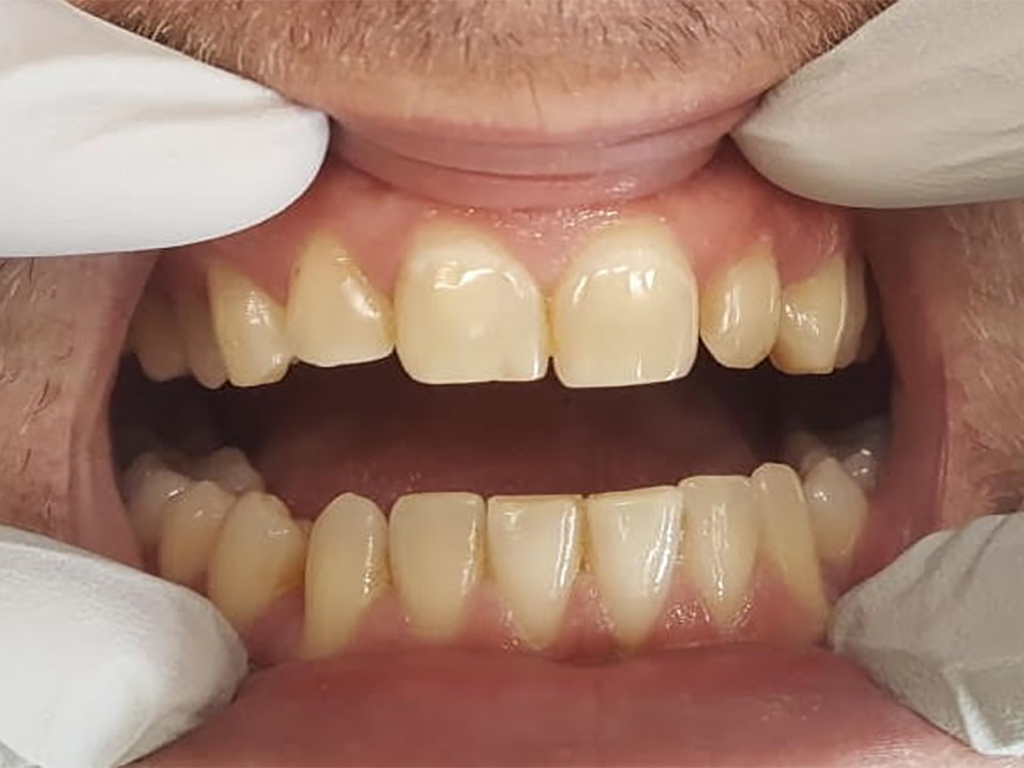 Before-Tanden en kiezen worden verlengd en aangepast in kleur en formaat