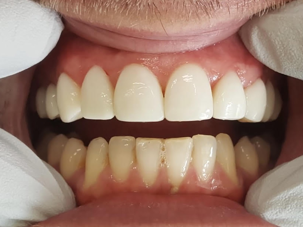After-Tanden en kiezen worden verlengd en aangepast in kleur en formaat
